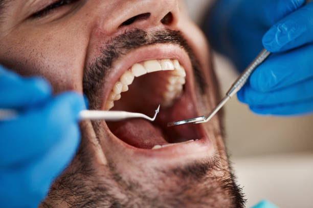 Best Emergency Dentist for Knocked-Out Tooth in North Liberty, IA